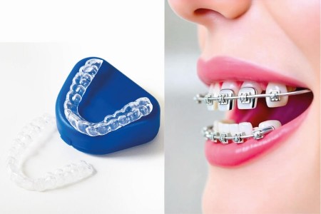 Invisalign or Braces: Which Treatment is Better?